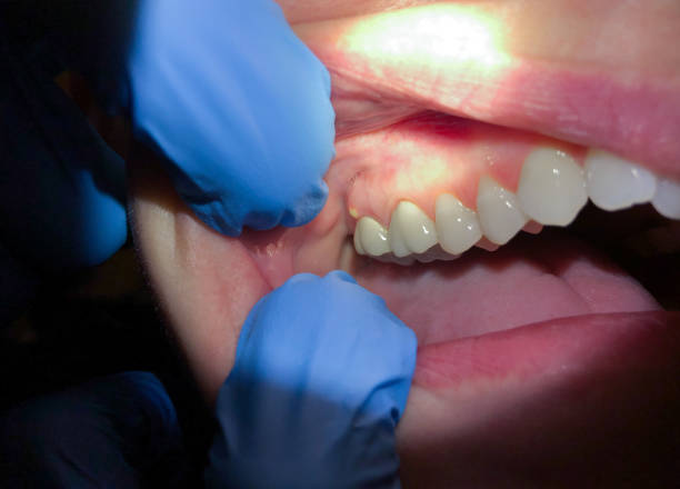 Best Emergency Dental Care for Broken or Chipped Teeth in Visalia, CA